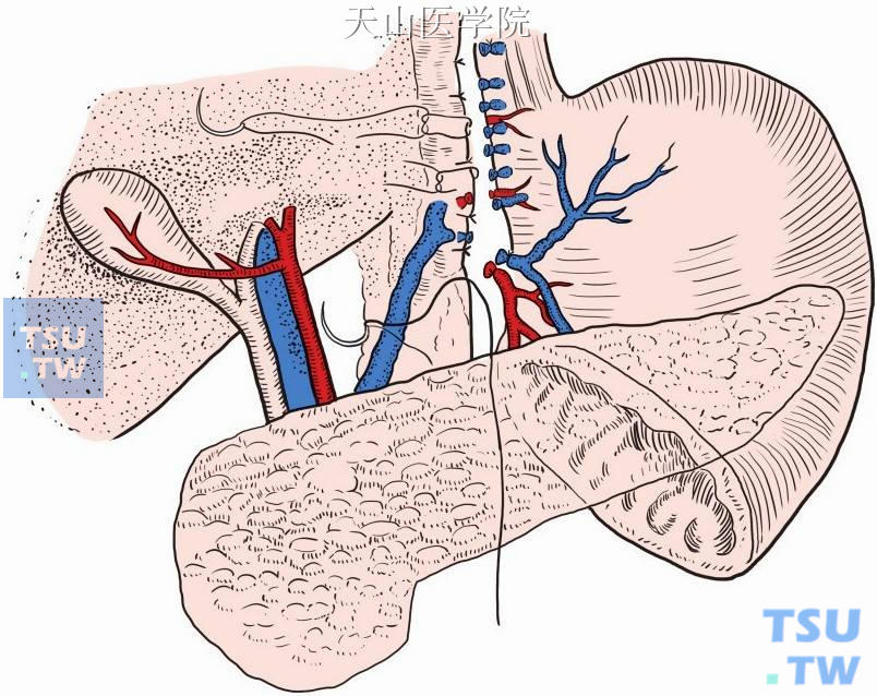 用细针线缝补食管旁静脉左侧缘的前后壁浆膜层、缝补胃胰襞创面，包埋穿支静脉和胃支动（静）脉的断端，以防线结滑脱而出血，并防止新生血管重新长出和进入食管下端