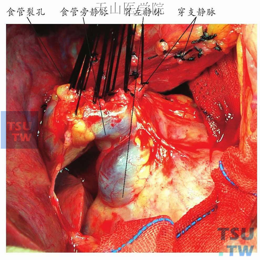 选择性断流术后保留完整的食管旁静脉（即胃左静脉食管支）