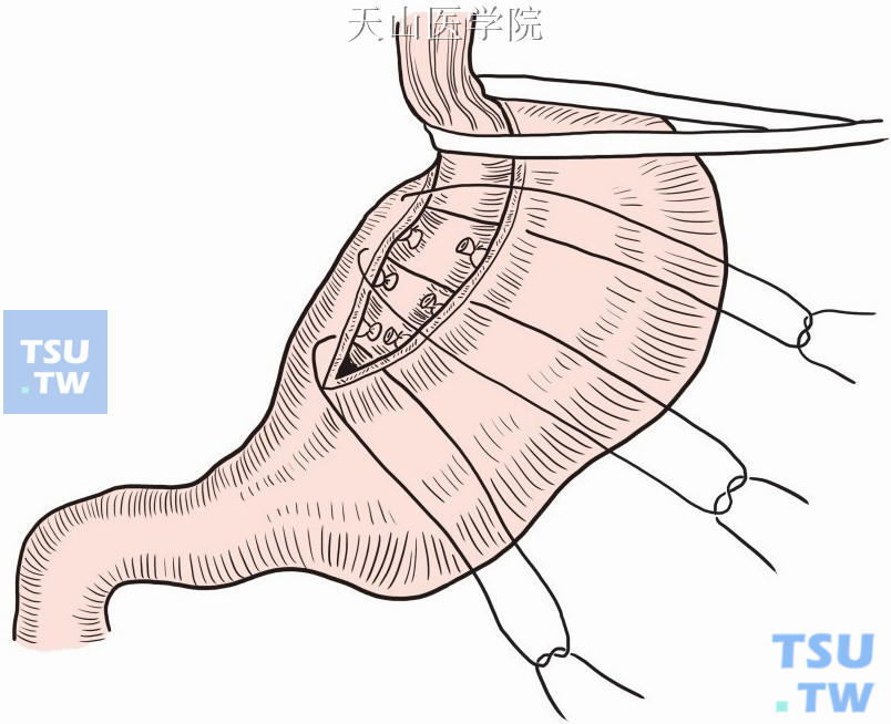 胃小弯前后壁的浆膜化