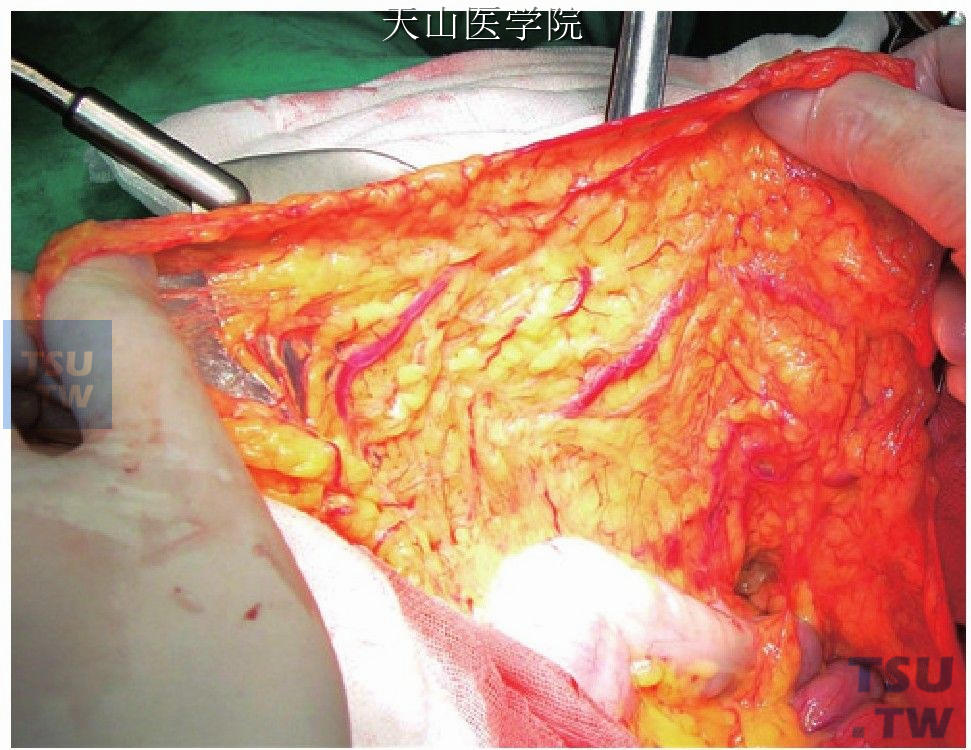 大网膜覆盖脾窝和腹后壁腹膜的创面