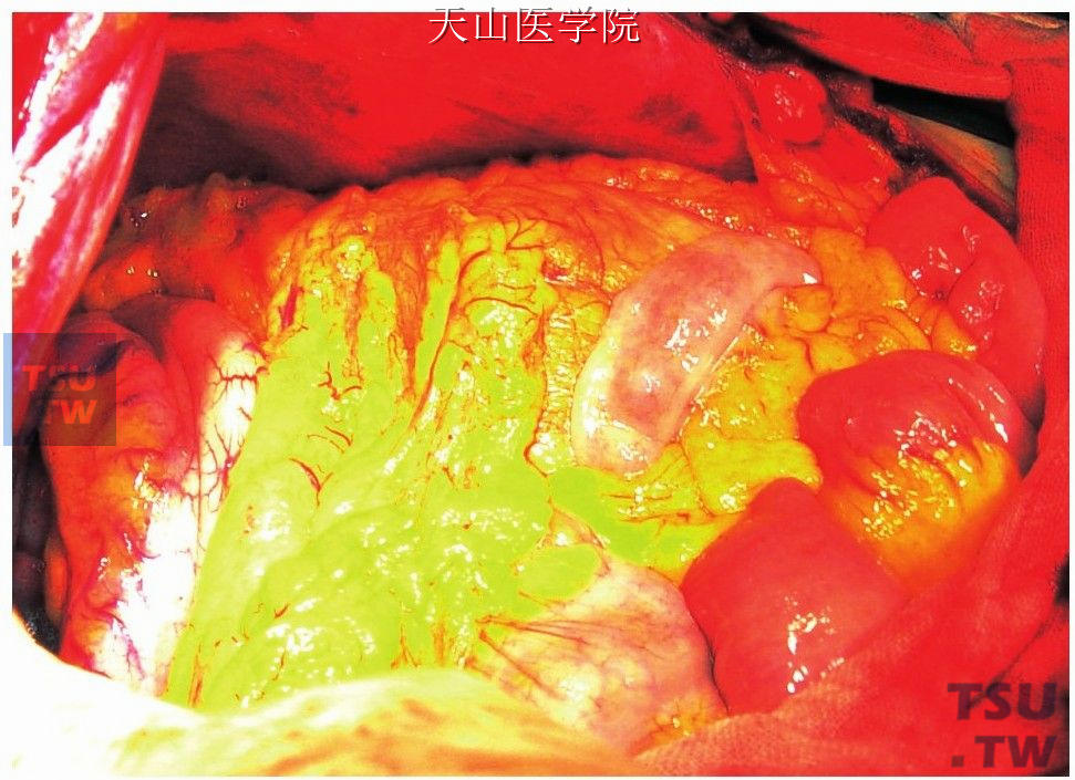 大网膜包肝术