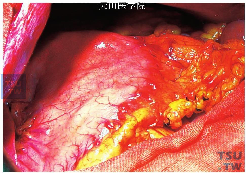 然后将大网膜翻转固定覆盖在横膈与肝面之间