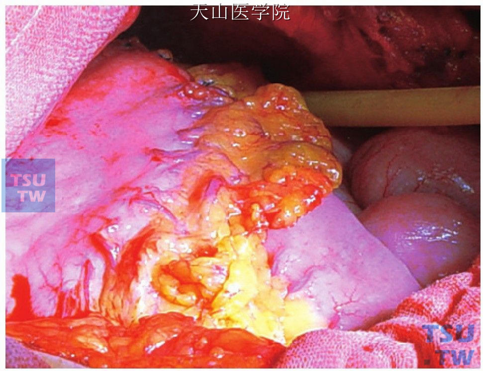 肝组织活检，左膈下置橡皮管引