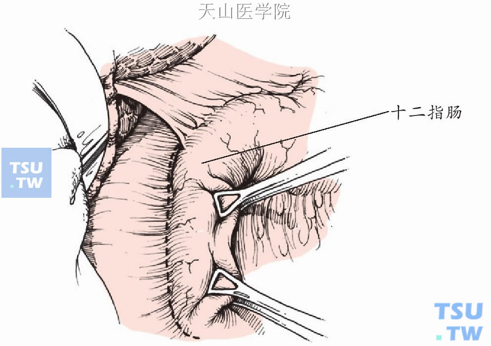 Kocher法切口打开十二指肠外侧后腹膜