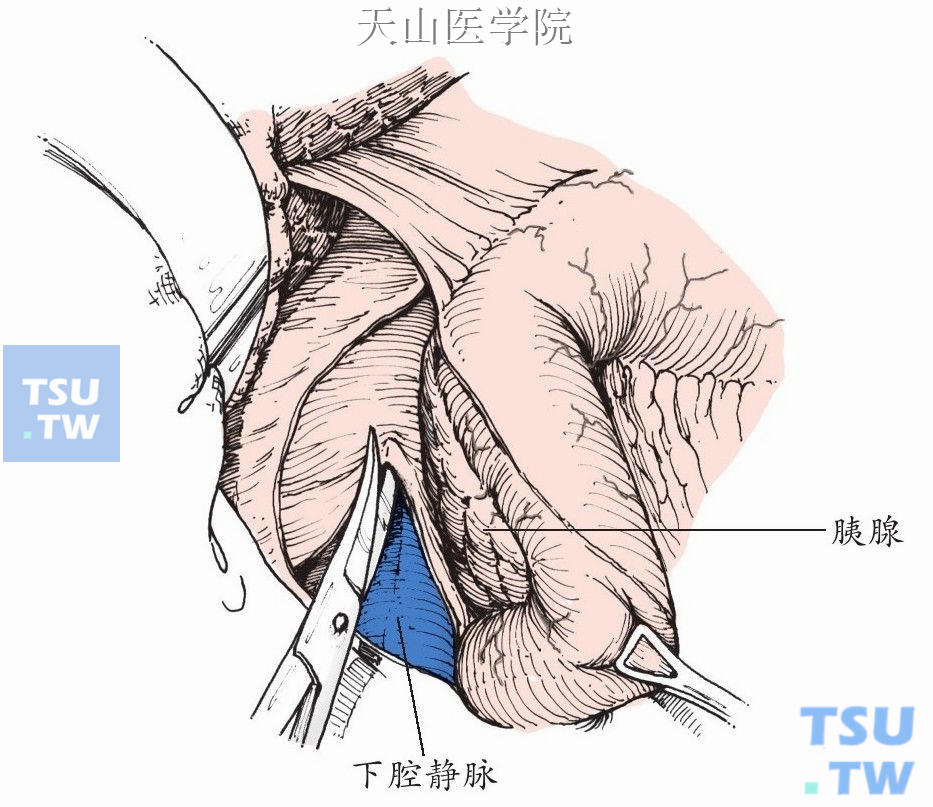 显露下腔静脉