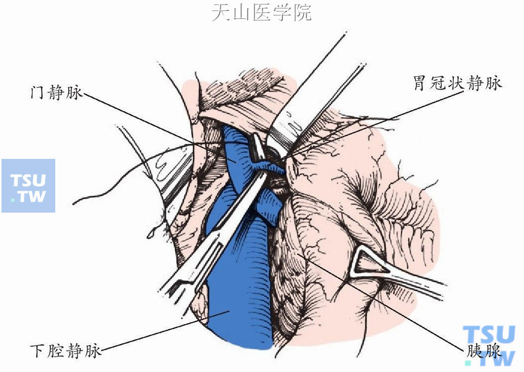 游离门静脉，结扎胃冠状静脉