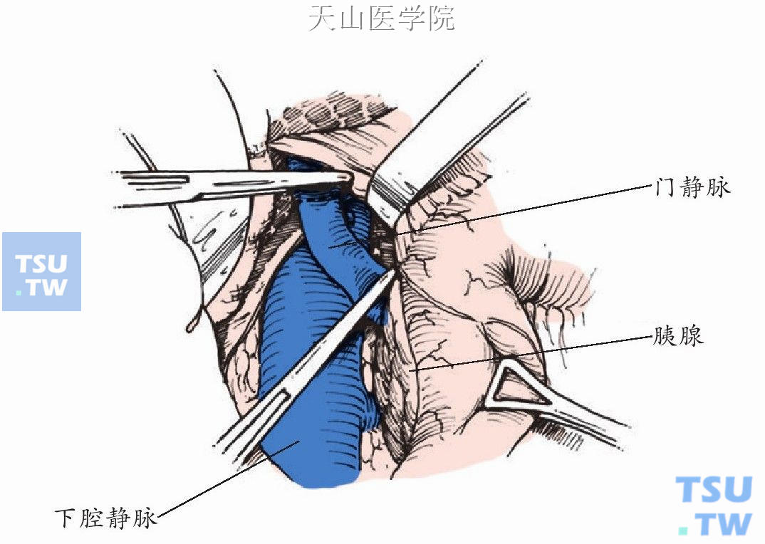钳夹门静脉主干的上下端，近肝侧离断