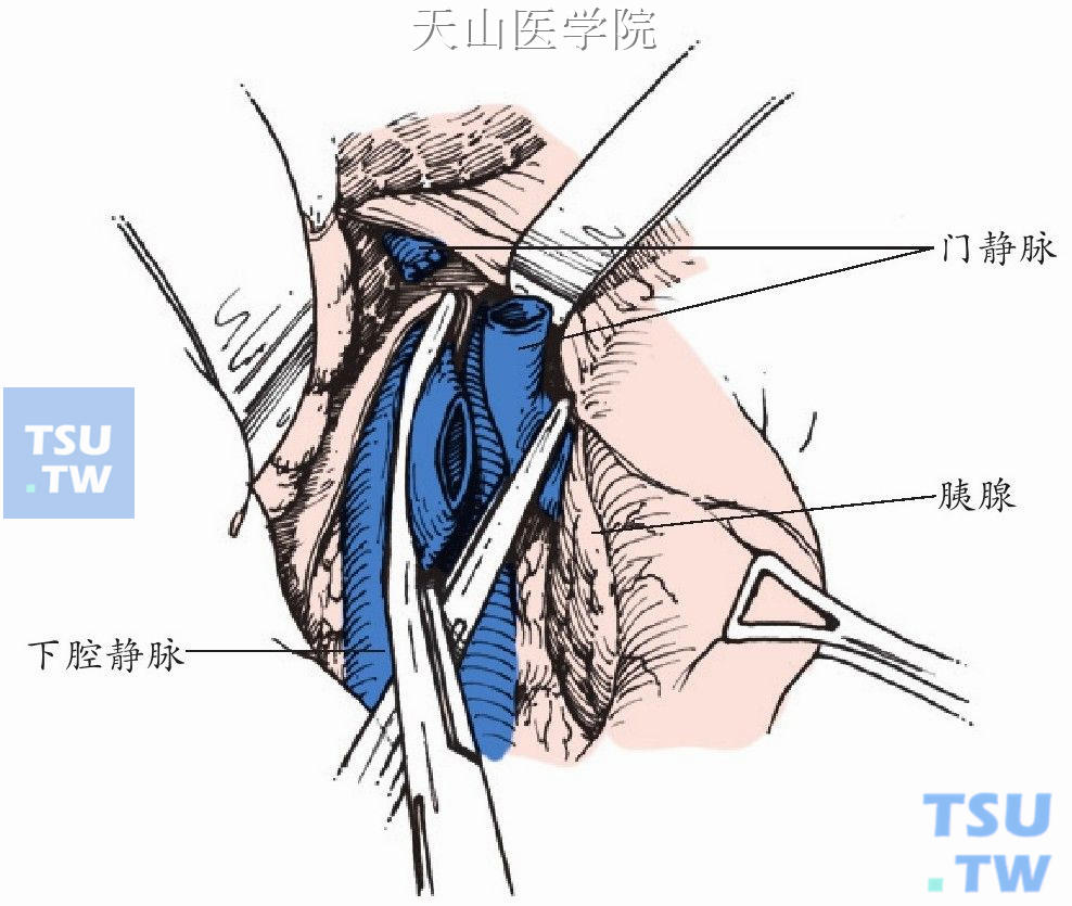 下腔静脉前壁切开