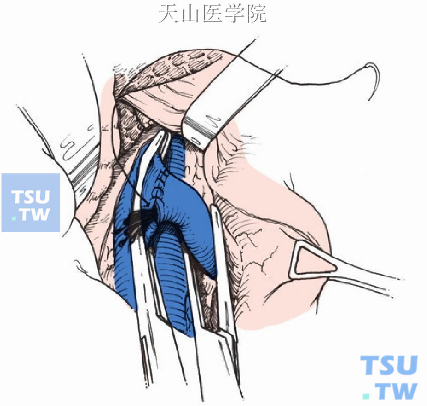 至于针眼处少量渗血，可用热生理盐水纱布压迫止血