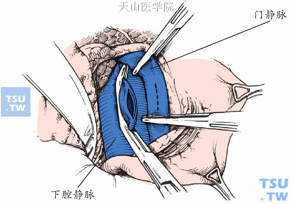 门静脉和下腔静脉壁分别切开