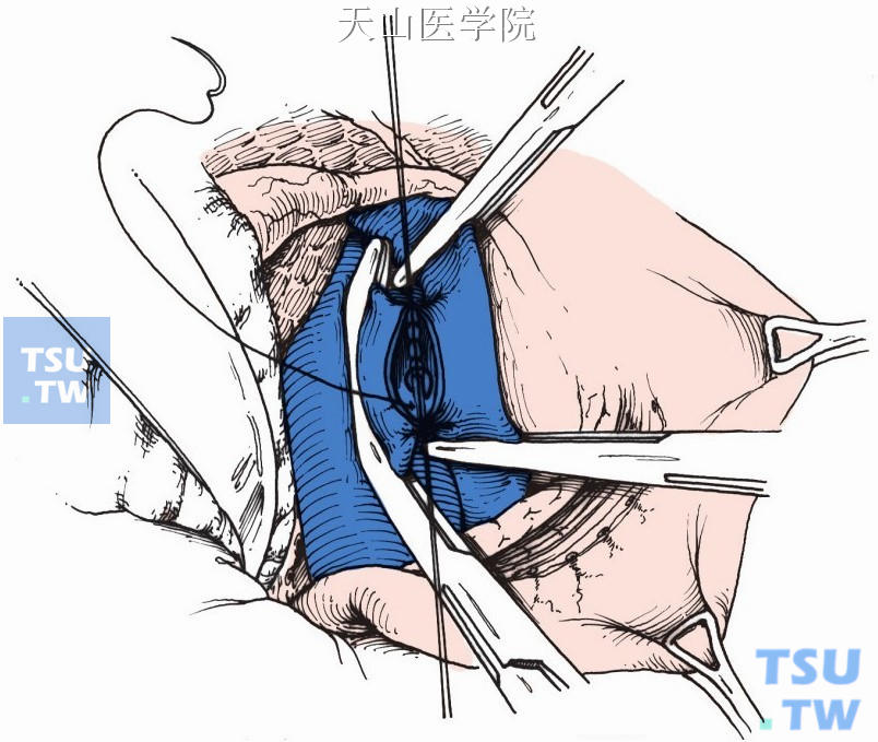 连续缝合门静脉与下腔静脉的后层