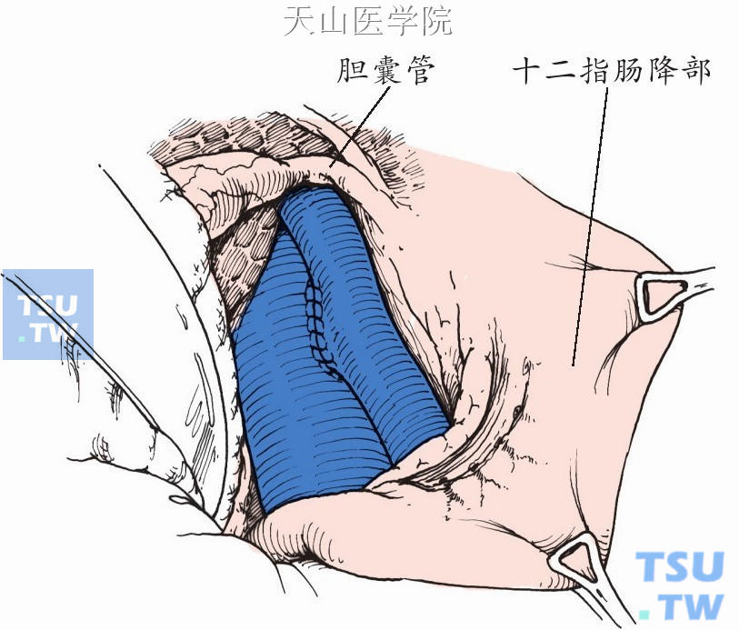 血管吻合完毕