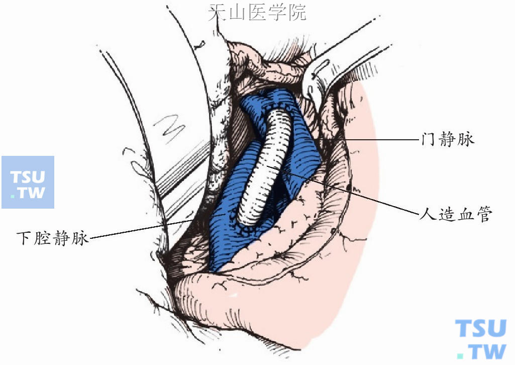 选择带支撑环的膨化聚四氟乙烯人造血管（ePTFE）行桥式分流，直径为8～10mm