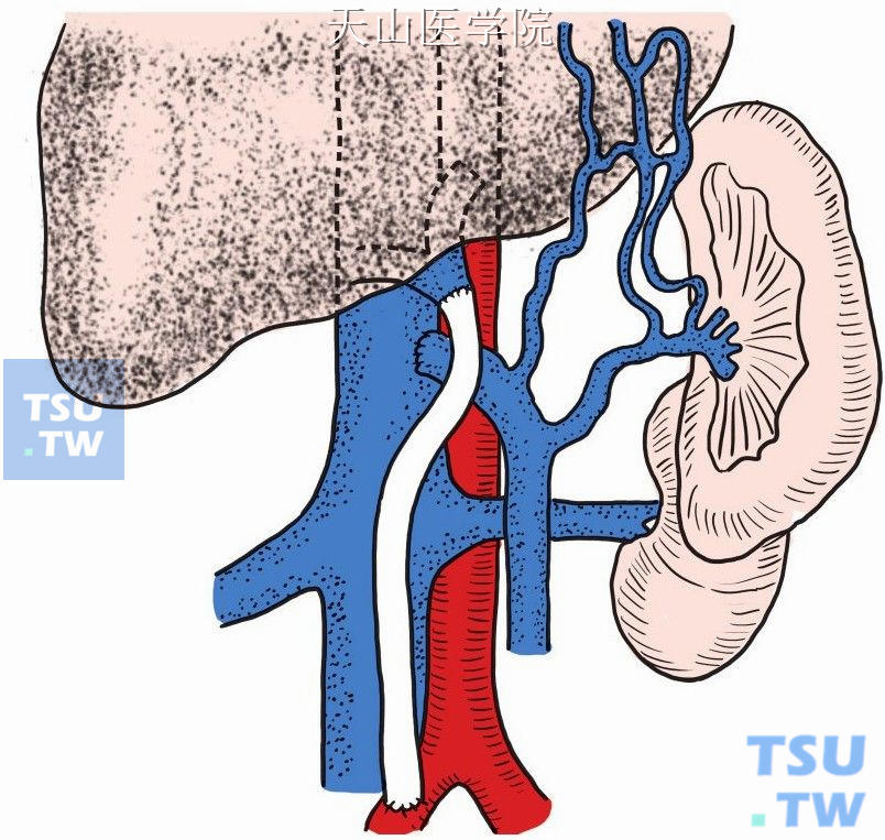门腔静脉端侧分流术加右髂总动脉与门静脉残端间移植