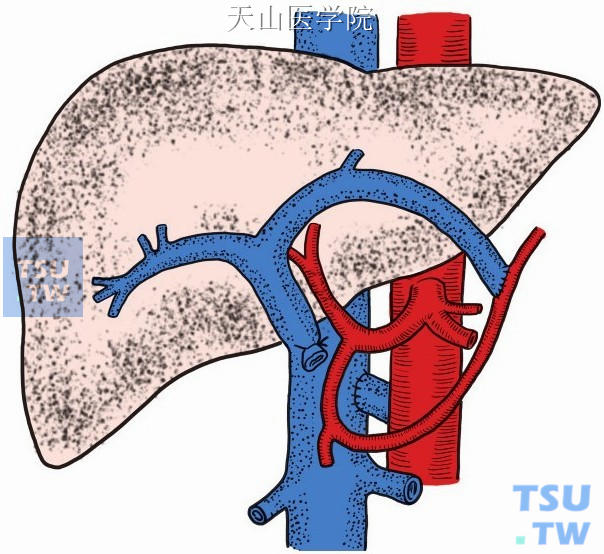 门腔端侧静脉分流术加门静脉动脉化