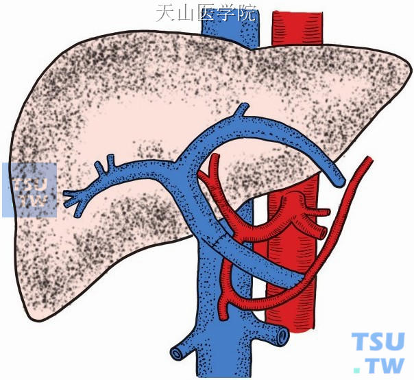 门腔静脉端侧分流术加自体静脉间置移植于门静脉残端与胃网膜右动脉间