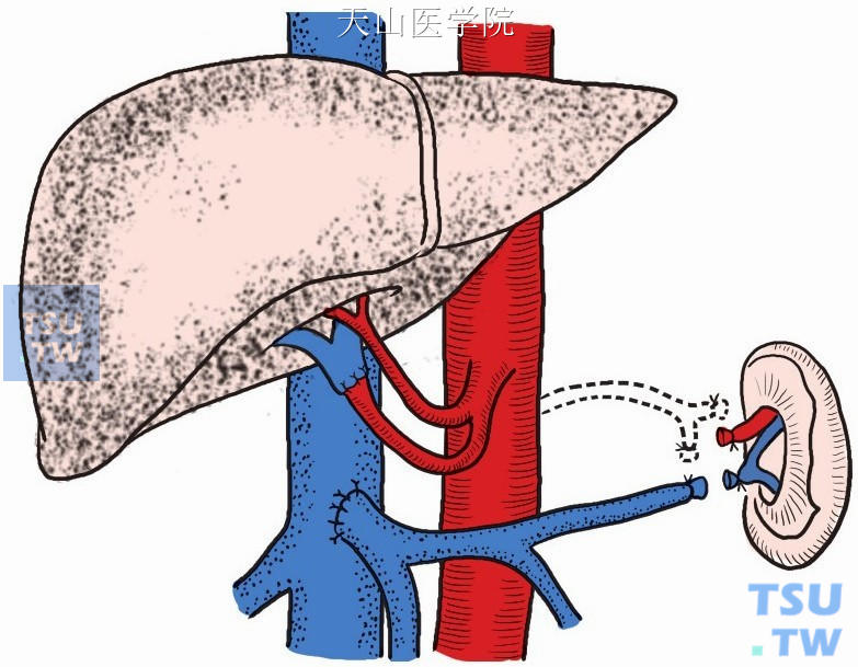 门腔静脉端侧分流术伴肝内门静脉动脉化