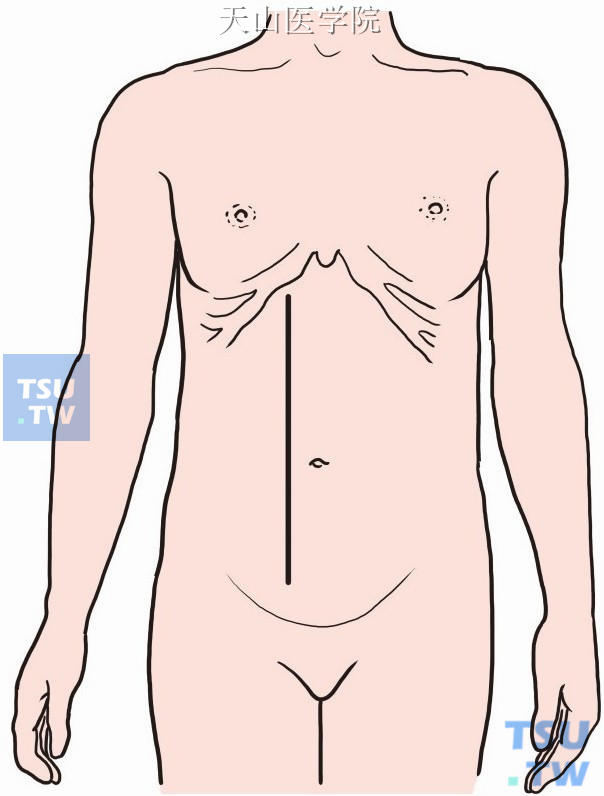 取右侧经腹直肌切口