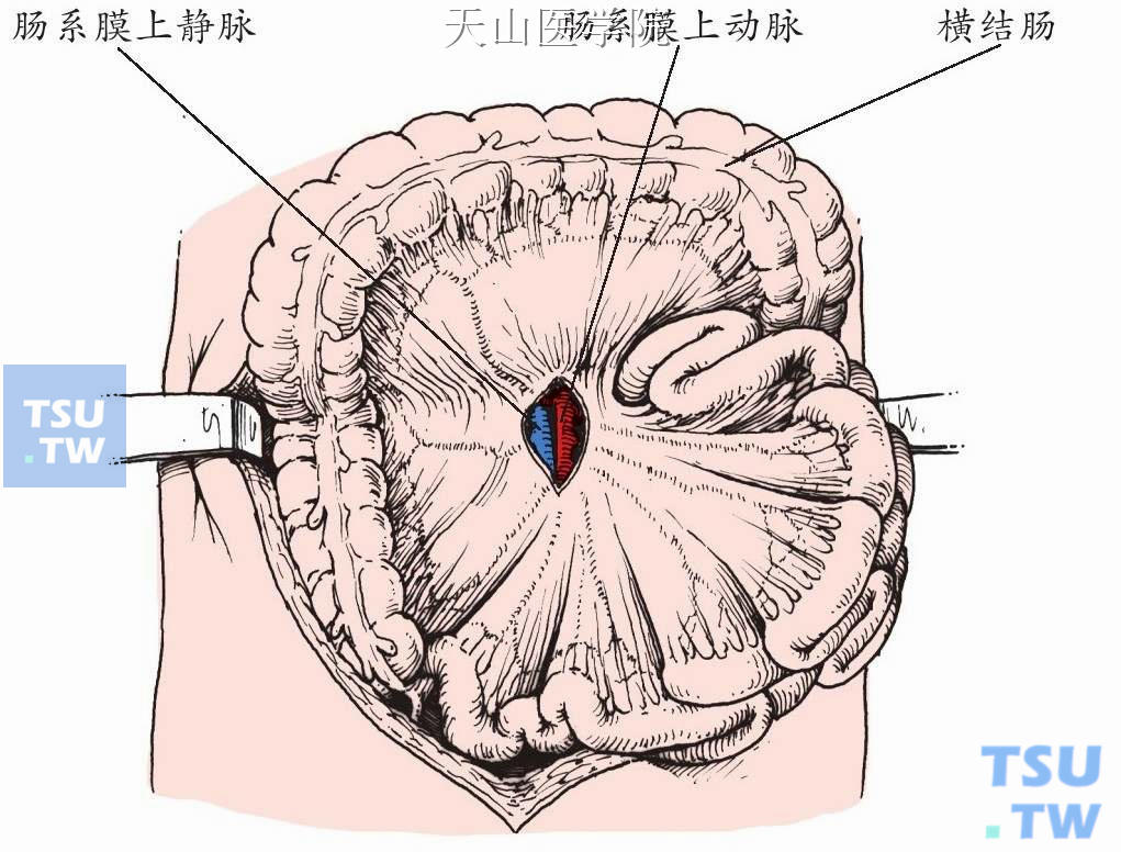 在横结肠系膜根部显露肠系膜上静脉