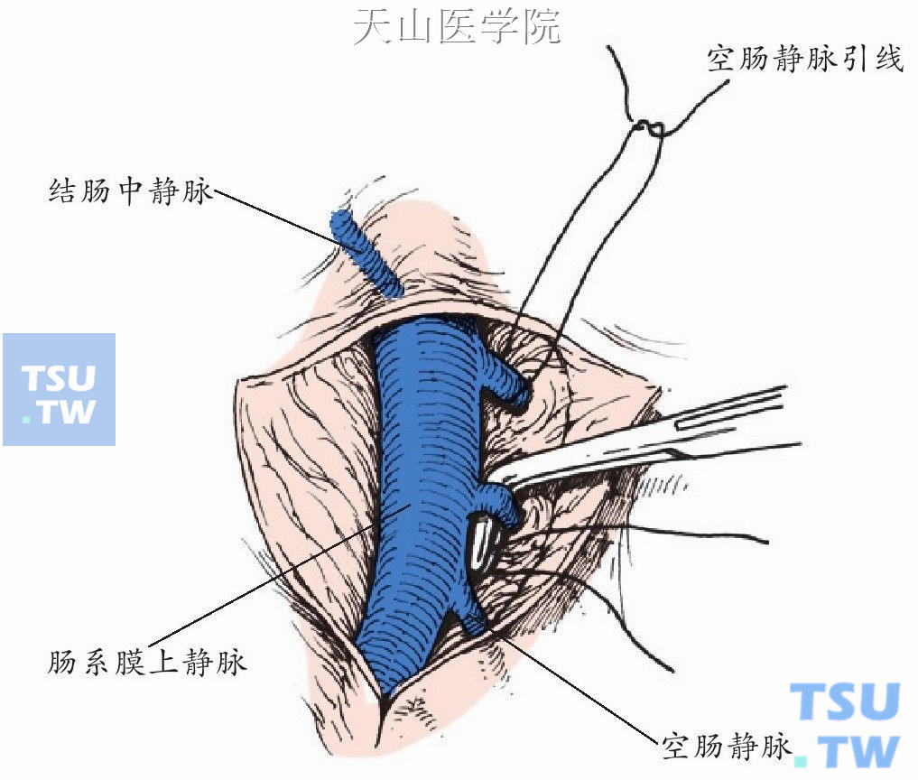 暂时阻断空肠静脉