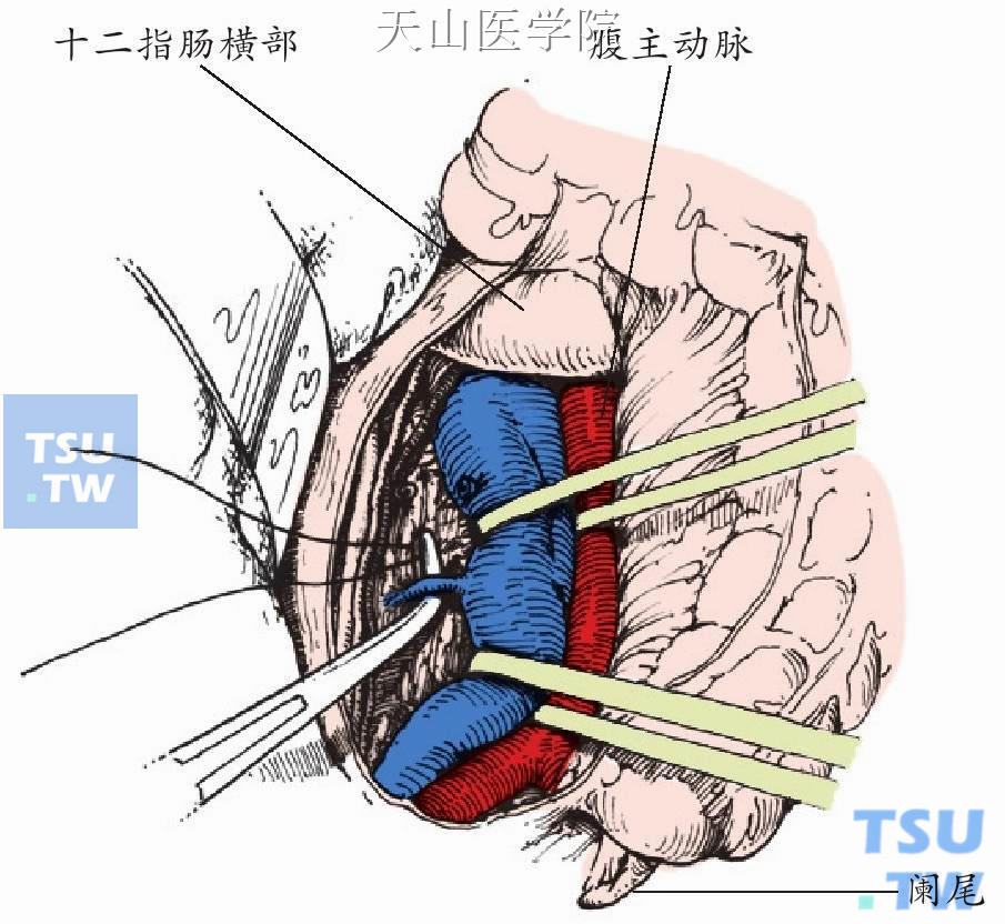 结扎切断下腔静脉的腰静脉分支