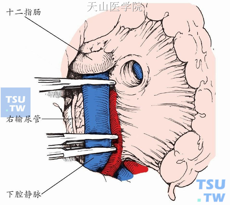 肠腔静脉侧端分流术（Clatworthy分流术）