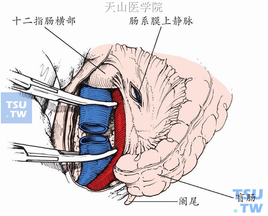 切断下腔静脉