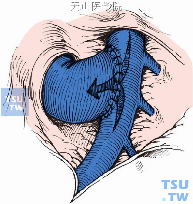 肠腔静脉侧端分流术完毕示意如图