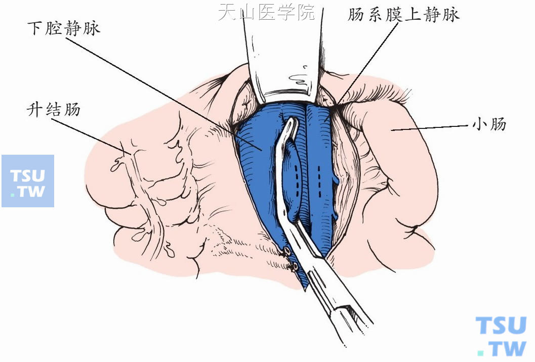 心耳钳钳夹下腔静脉的部分侧壁