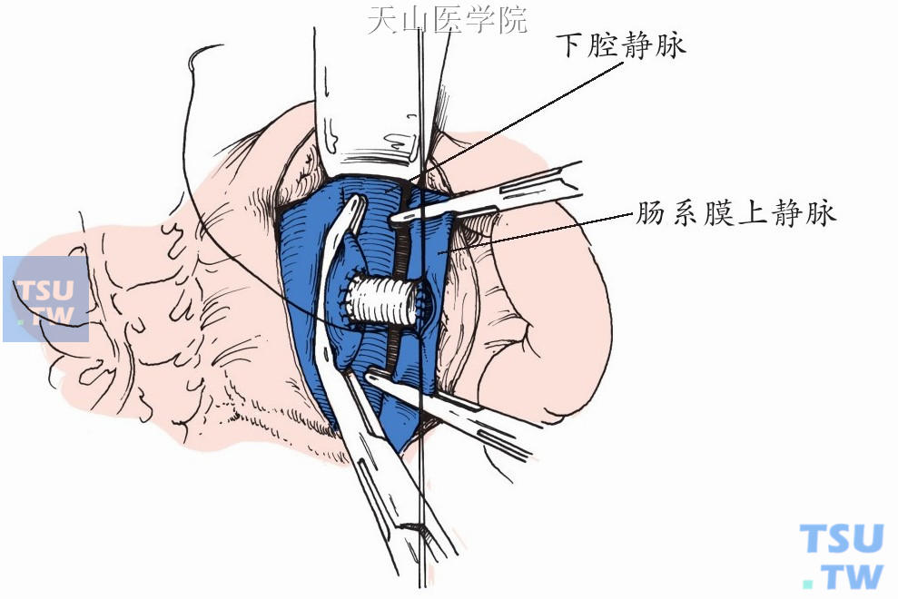 聚四氟乙烯人造血管架桥