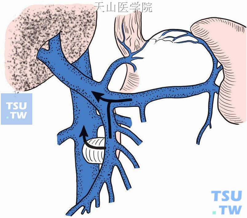 肠腔静脉桥式分流术示意如图