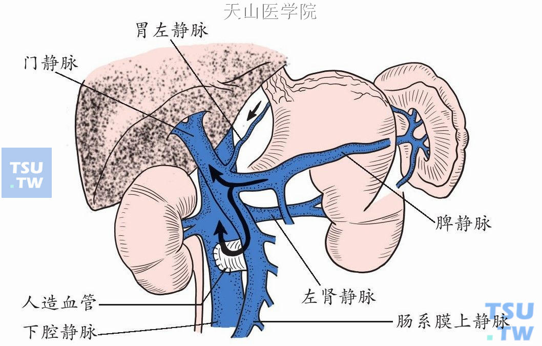 肠系膜上静脉与下腔静脉“H”形架桥分流术示意如图