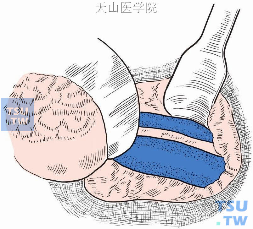 肠腔静脉侧侧分流术