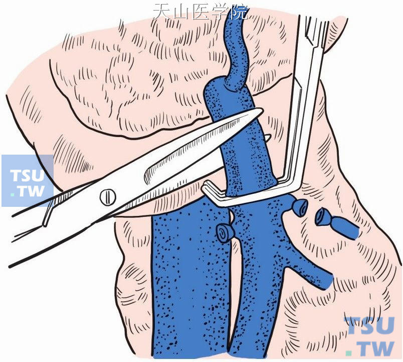 在结肠中静脉以下水平切断肠系膜上静脉的“外科干”