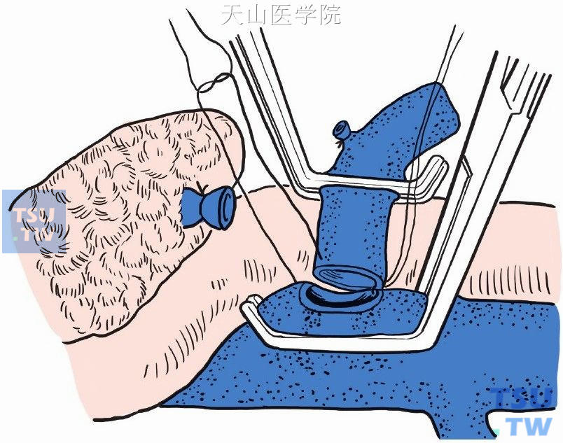 肠系膜上静脉远心端与下腔静脉行端侧吻合