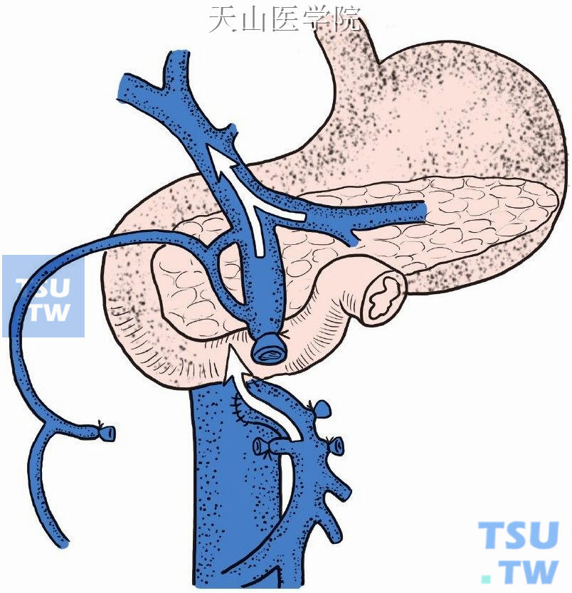 肠腔静脉端侧分流术血流方向示意如图
