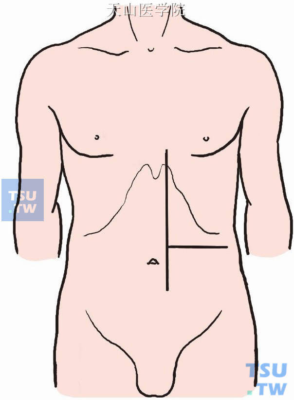 上腹部直切口和横切口