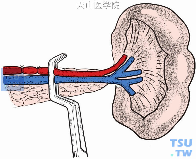 脾肾静脉分流术