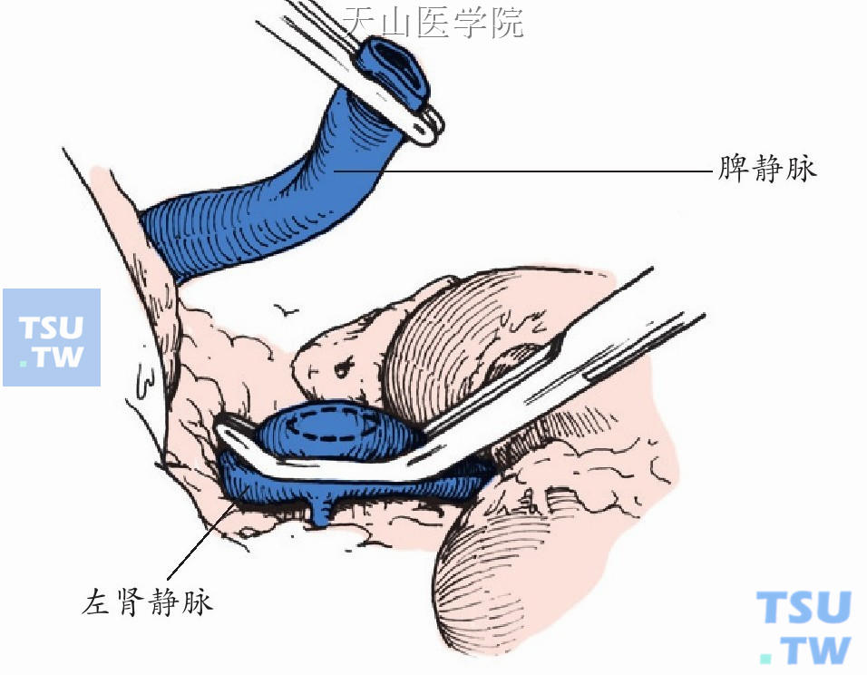 肾静脉前壁做一相当于脾静脉口径的卵圆形切口