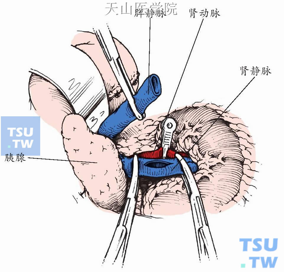 脾肾静脉端侧分流术