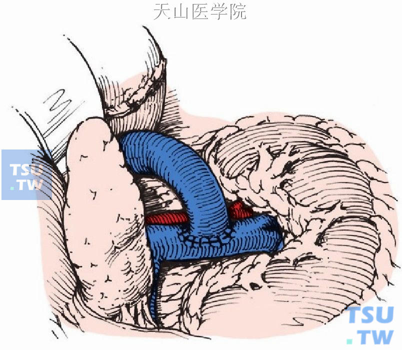 脾肾静脉端侧分流术完毕