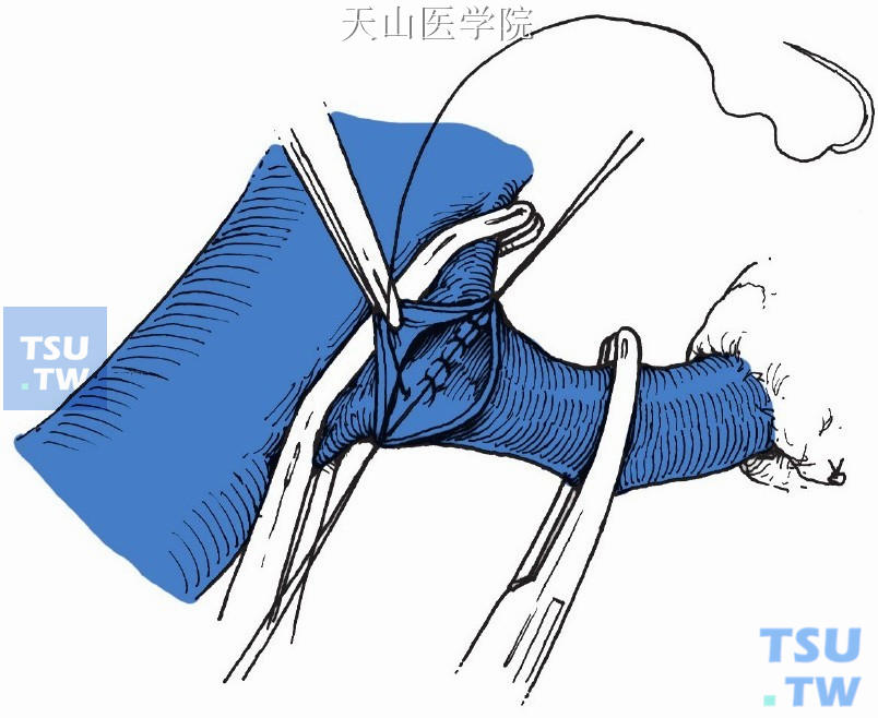 脾静脉下腔静脉端侧后壁吻合