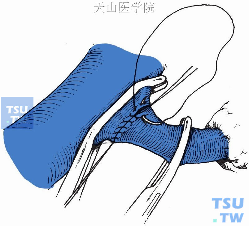 外翻连续缝合脾腔静脉吻合口的前壁