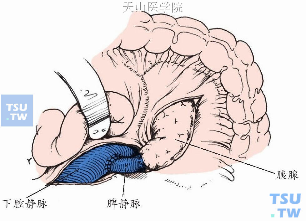 胰包膜同横结肠系膜孔和后腹膜组织缝合固定