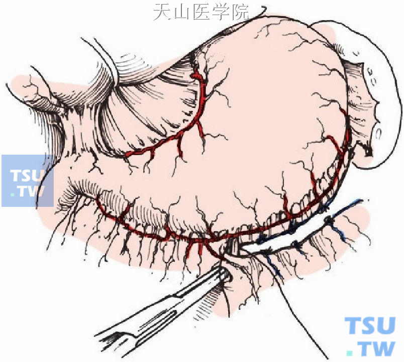 离断胃大网膜血管