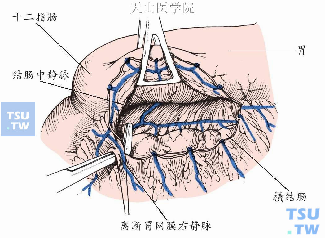 选择性远端脾肾静脉分流术（DSRS, Warren术）