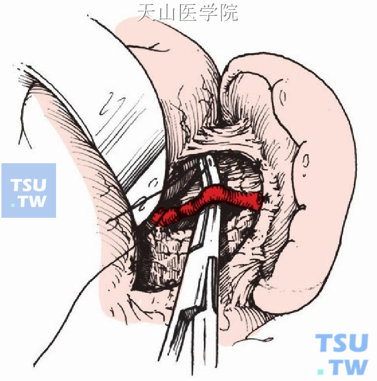胰体尾上缘分离脾动脉