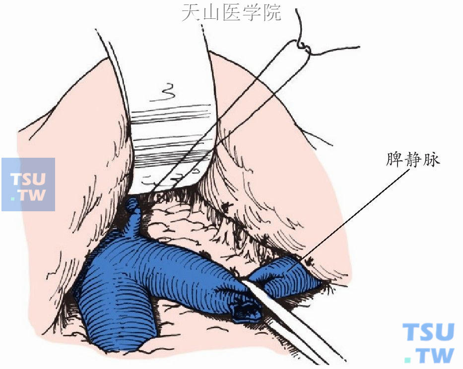 脾静脉游离