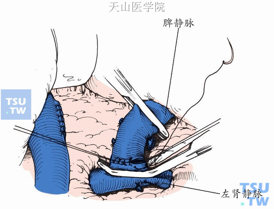 远端脾静脉左肾静脉端侧吻合