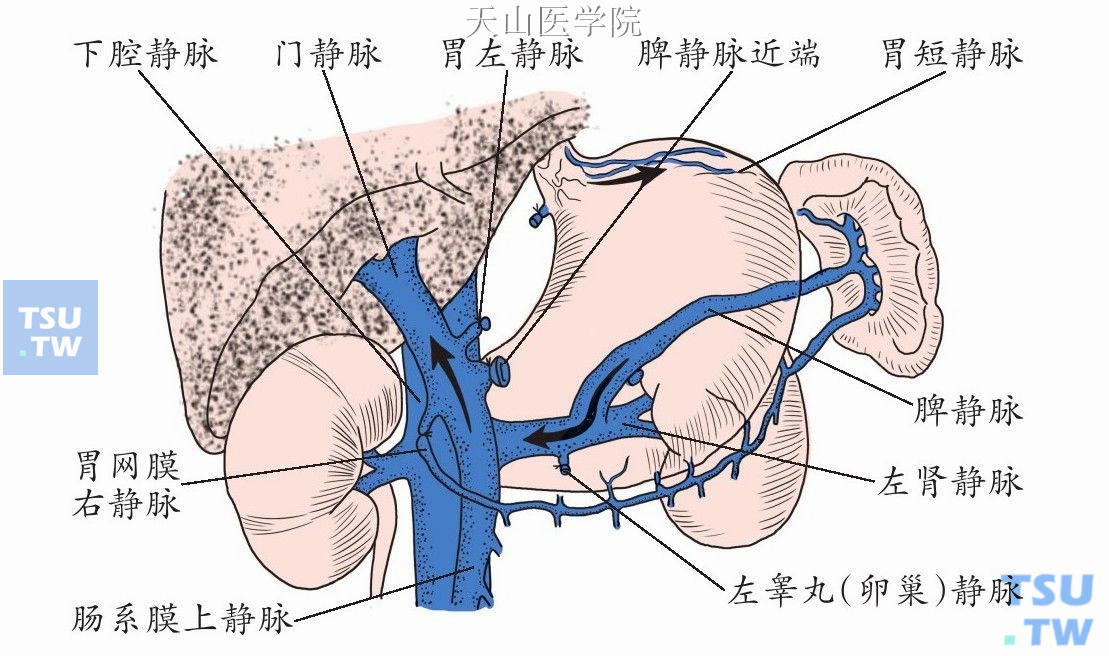 胃小弯侧门奇静脉断流术